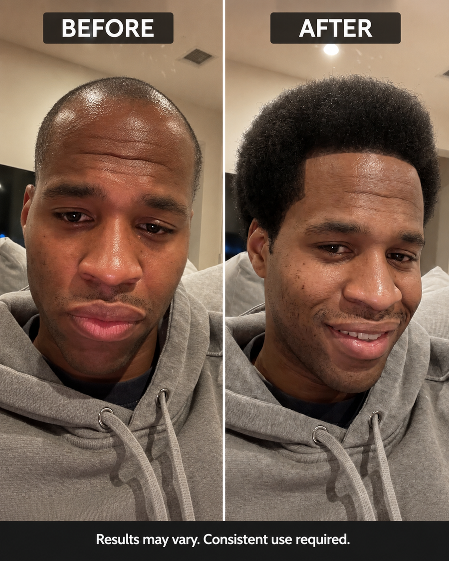 "I wasn't expecting much honestly. But 5 weeks in my hairline started coming back and the crown is way fuller now. I use it with the derma roller like they recommend and I think that's what made the difference."— Lungelo D., Johannesburg ★★★★★