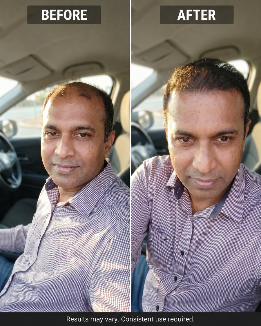 "I noticed the thinning on top about a year ago and tried a few things that did nothing. Gave this a proper try for 2 months and the regrowth is real. My wife noticed before I even said anything."— Priven N., Durban ★★★★★