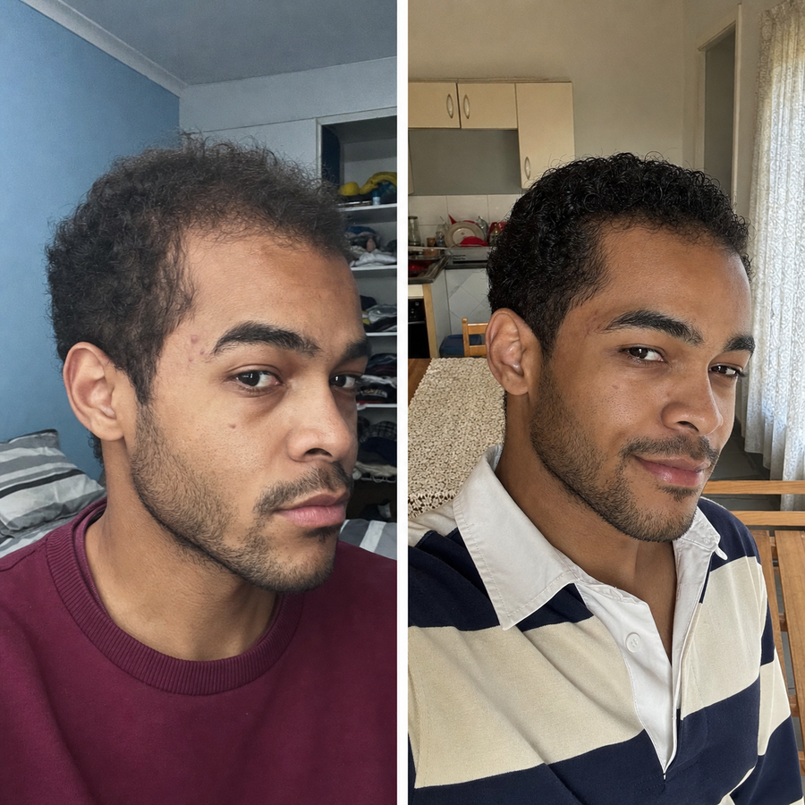 "I noticed the thinning on top about a year ago and tried a few things that did nothing. Gave this a proper try for 2 months and the regrowth is real. My wife noticed before I even said anything."— Priven N., Durban ★★★★★